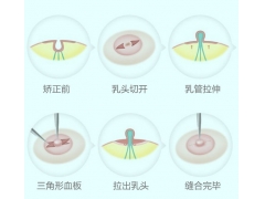 上海哪家医院治疗乳头内陷好