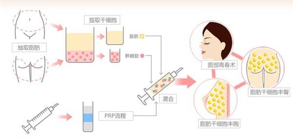 关于自体脂肪丰胸有什么后遗症吗