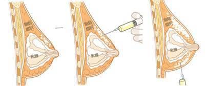 关于自体脂肪丰胸有什么后遗症吗