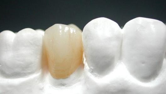 烤瓷牙齿矫正会对我们造成什么伤害吗