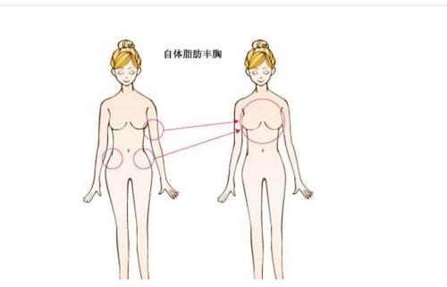 自体脂肪隆胸美莱一般需要多少钱啊