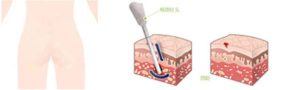 上海做共振吸脂手术安全吗