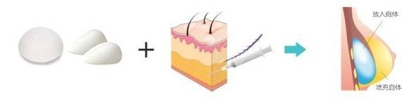 自体脂肪隆胸我们需要知道什么呢