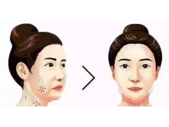 “埋线提升提拉”|美莱整形说有些人不适合做