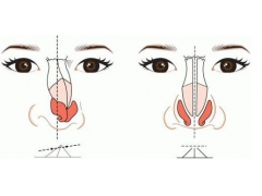 假体隆鼻多少钱在上海地区