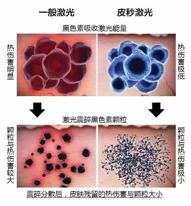 美莱皮秒激光的优势究竟在哪里