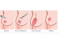 上海整形医院乳房下垂矫正怎么做