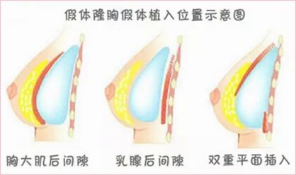 上海假体隆胸手术自然吗