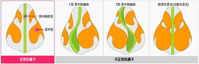 美莱自体耳软骨隆鼻好吗