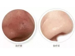 上海美莱皮肤清洁—皮肤蜕变的选择