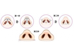 上海做鼻孔缩小手术安全