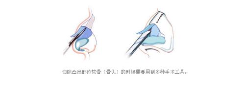 上海矫正驼峰鼻一般如何矫正