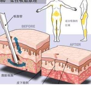 水动力吸脂可以瘦大腿吗