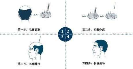 上海做自体毛发移植术后注意事项有哪些