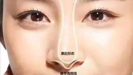 上海鼻子注射玻尿酸后注意的是什么