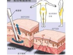 水动力吸脂可以瘦大腿吗