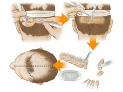 上海做自体毛发移植术后注意事项有哪些