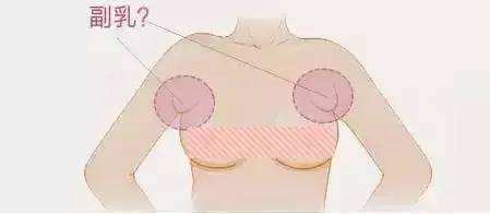 上海做副乳切除多少钱