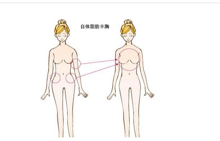 上海注射自体脂肪丰胸适合人群有哪些