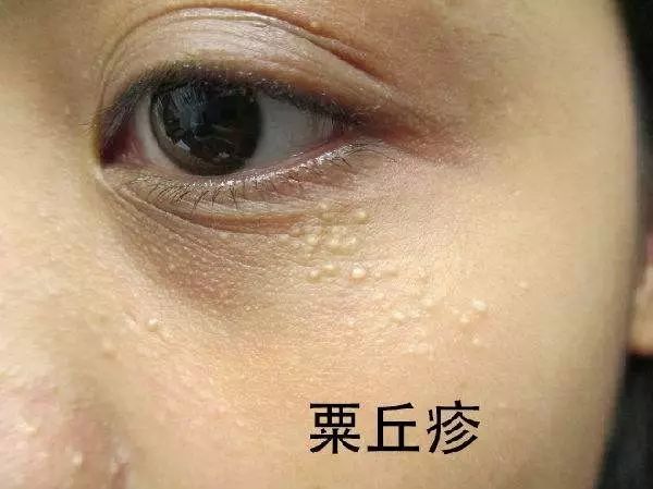 下眼睑脂肪粒怎么去除,激光去除怎么样