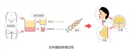 美莱做自体脂肪隆鼻的效果怎么样