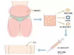 美莱做自体脂肪隆胸,一般都抽哪些部位