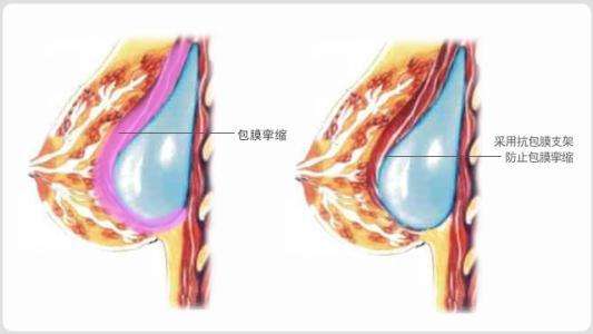 隆胸失败修复怎么做