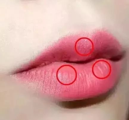 美莱介绍：玻尿酸丰唇后会影响正常的接吻吗