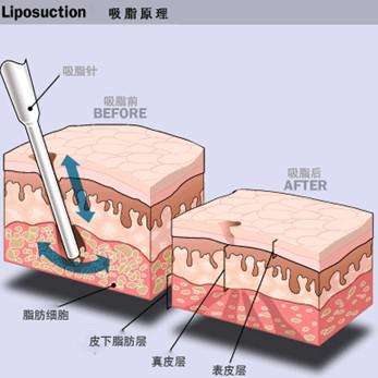 吸脂减肥的修复方法有哪些