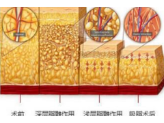 上海抽脂去哪家医院好