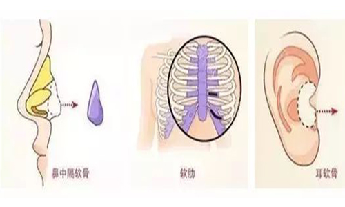 上海做肋软骨隆鼻后的鼻子会透光吗