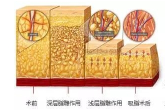 什么人适合吸脂