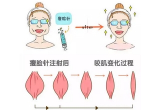 注射瘦脸搭配什么针一起打啊