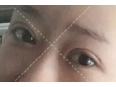 美莱祛眼袋手术的优点