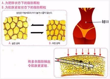 吸脂减肥术后会不会出现什么其他影响啊