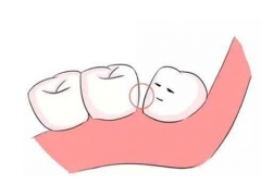 牙齿不整齐矫正的方法有几种