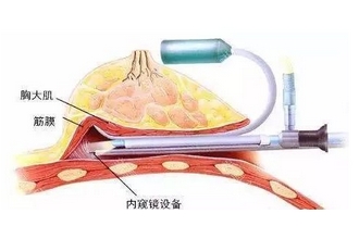 内窥镜隆胸的优势