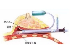 内窥镜隆胸的优势