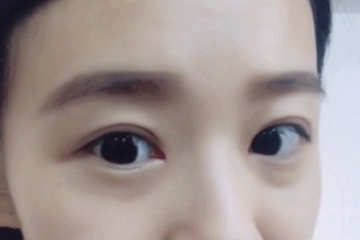 什么情况适合开眼角