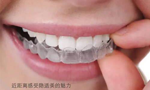 牙齿矫正一般需要多长时间才能变整齐