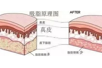 吸脂会减重吗