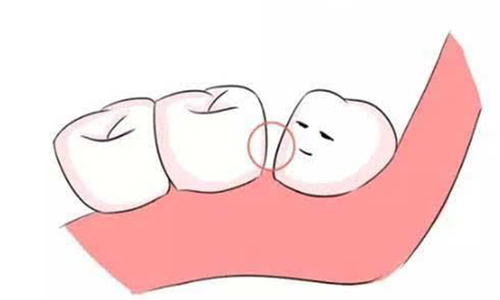 牙齿不齐的危害有哪些