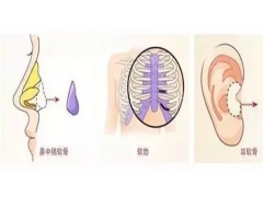 上海做耳软骨隆鼻手术需要多少钱