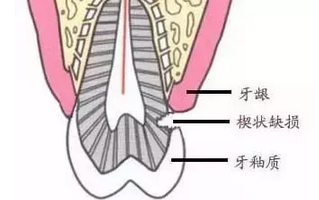 酸倒牙是怎么回事