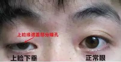 什么是上睑下垂，上睑下垂一定要手术吗
