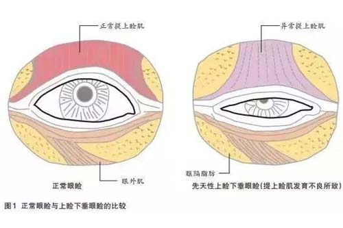 上睑下垂矫正后一般能保持几年