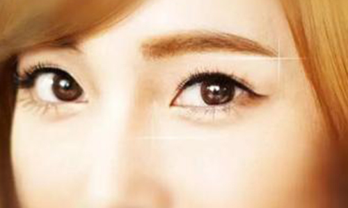双眼皮整形手术都有哪几种类型