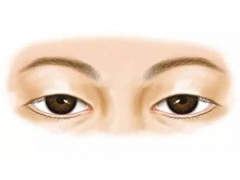 上睑下垂矫正后一般能保持几年