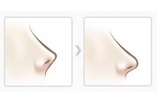 什么样的鼻子适合做综合鼻