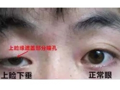 上睑下垂矫正手术哪家医院做更专业